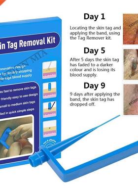 Blue Set Skin Tag Removal Kit Home Use Mole Wart Remover Equ