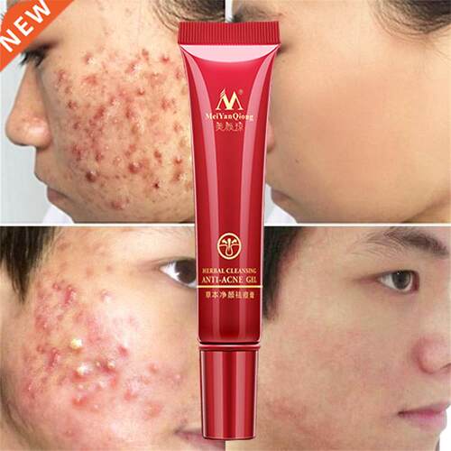 Effective Acne Removal Cream Herbal Anti-acne Repair Fade Ac