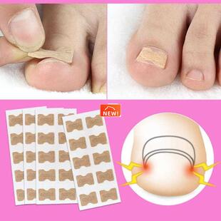 10/20PCS Ingrown Toenail Correction Stickers Glue Free Ing