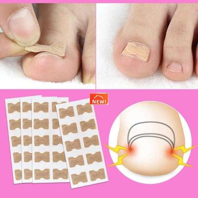 10/20PCS Ingrown Toenail Correction Stickers Glue Free Ing