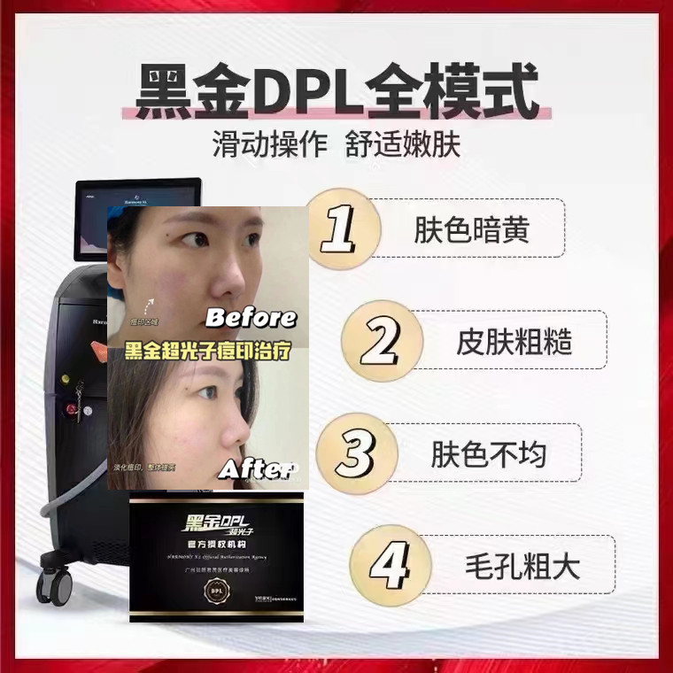 黑金超光子m22光子嫩肤紧致提拉仪器牛奶光全模式dpl美容院专用