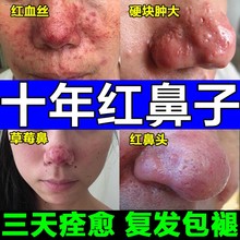 酒糟鼻草莓鼻修复专用药膏治红鼻子去黑头除螨鼻翼两侧毛孔粗大药