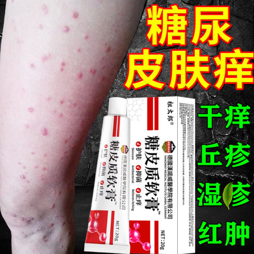 糖尿病老年人皮肤痒专用止痒膏药