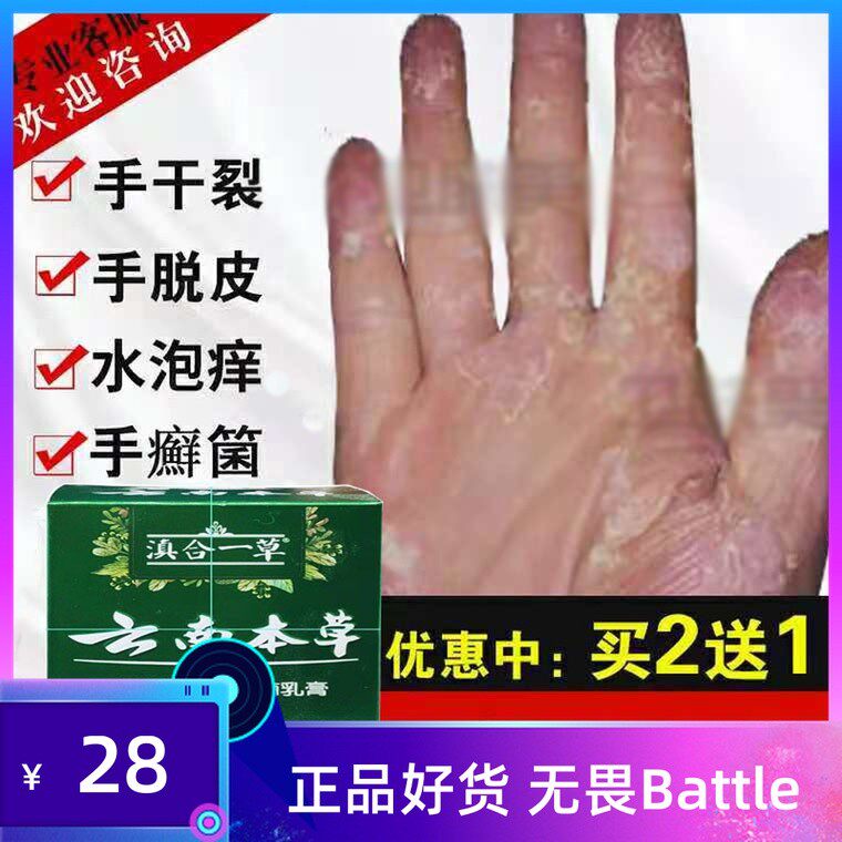 治手脚真菌感染止痒药脱皮脚痒膏