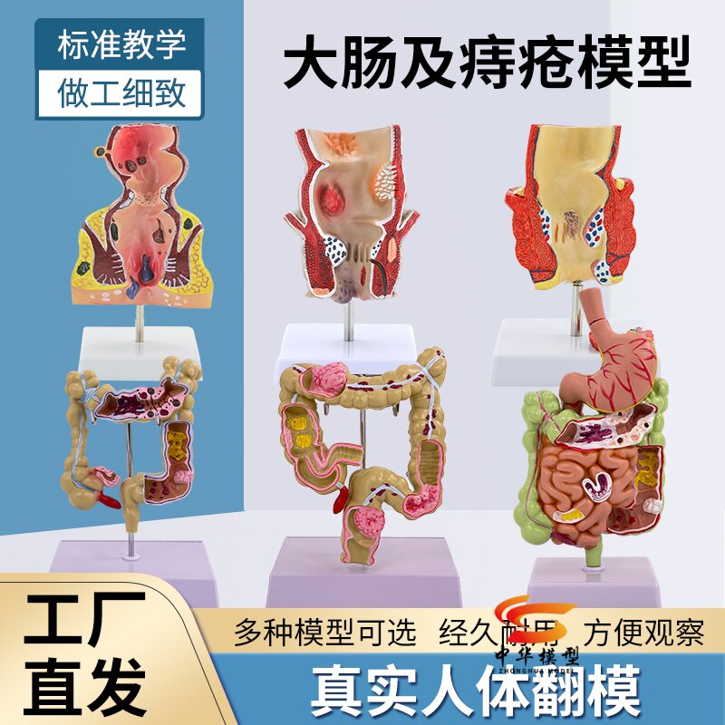 大肠病理模型直肠模型肠胃病变解剖模型肠道疾病人体结肠病变模型