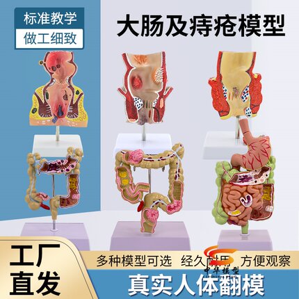 大肠病理模型直肠模型肠胃病变解剖模型肠道疾病人体结肠病变模型