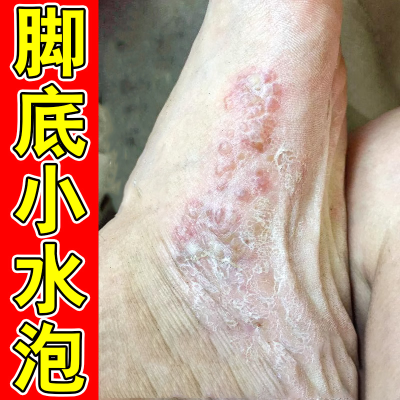 脚底上起小水泡又痒又脱皮脚底痒脚痒掉皮脚脱皮痒喷剂药