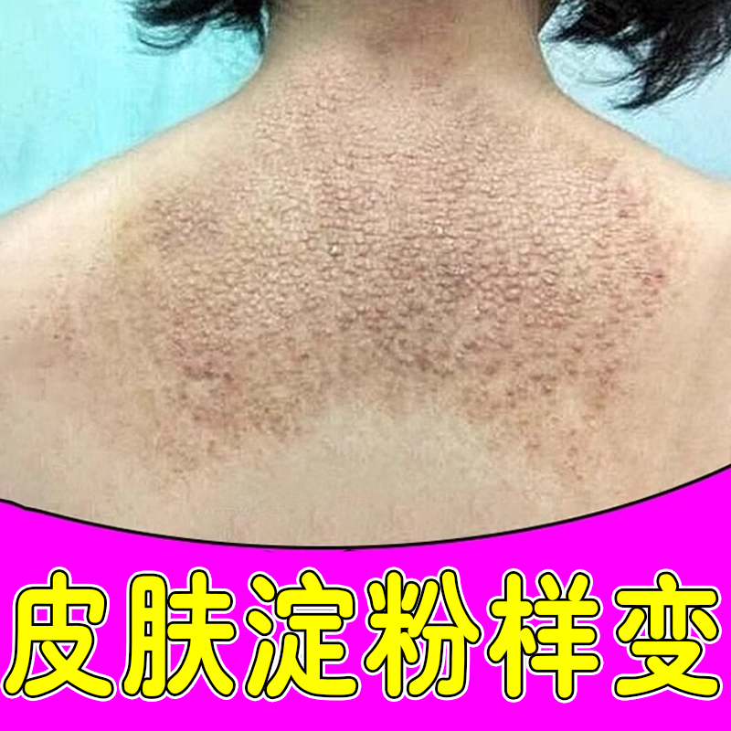皮肤淀粉样变药疗顽固皮斑状小腿后背皮肤痒起小疙瘩颗粒痘痒软膏