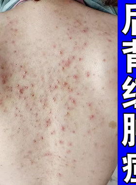 背上长螨虫疙瘩后背疙瘩膏前胸后背起脓包外用药身上痒软膏