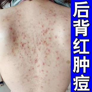 背上长螨虫疙瘩后背疙瘩膏前胸后背起脓包外用药身上痒软膏