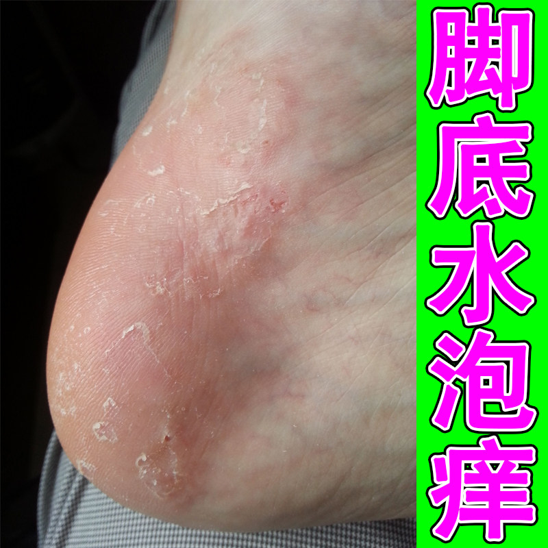 脚底水泡痒起皮脱皮真菌脚后跟干燥粗糙掉皮蜕皮外用修复脚脱皮药