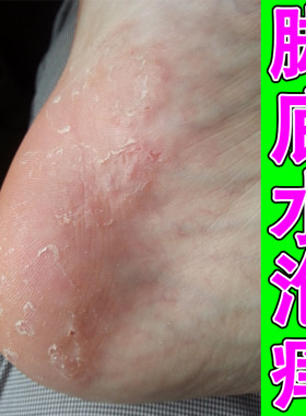 脚底水泡痒起皮脱皮真菌脚后跟干燥粗糙掉皮蜕皮外用修复脚脱皮药