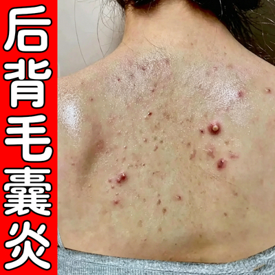 后背毛囊炎马拉色菌背后长痘痘红肿脓包痒螨虫痘外用