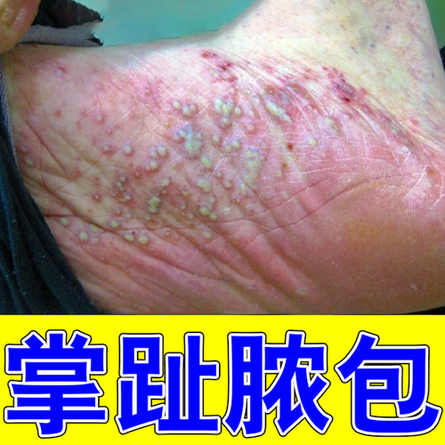 脚底起水泡脚脱皮干燥痒蜕皮干裂红斑