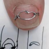 甲沟炎矫正钩正甲扣嵌甲矫正钩正甲贴指甲卷甲往肉里长脚指甲扎肉