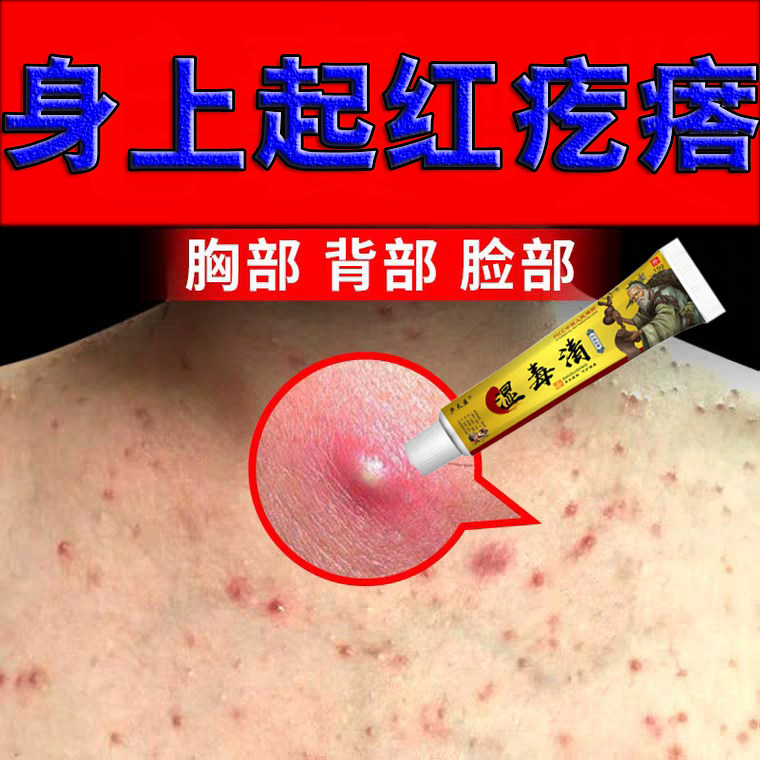 身上起红疙瘩痒前胸后背腿上头上脸上长头皮毛囊炎治疗皮肤痒的药