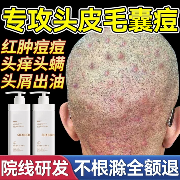 毛囊洗发水头痒头皮痒去屑止痒控油蓬松头皮深层清洁洗发露ks