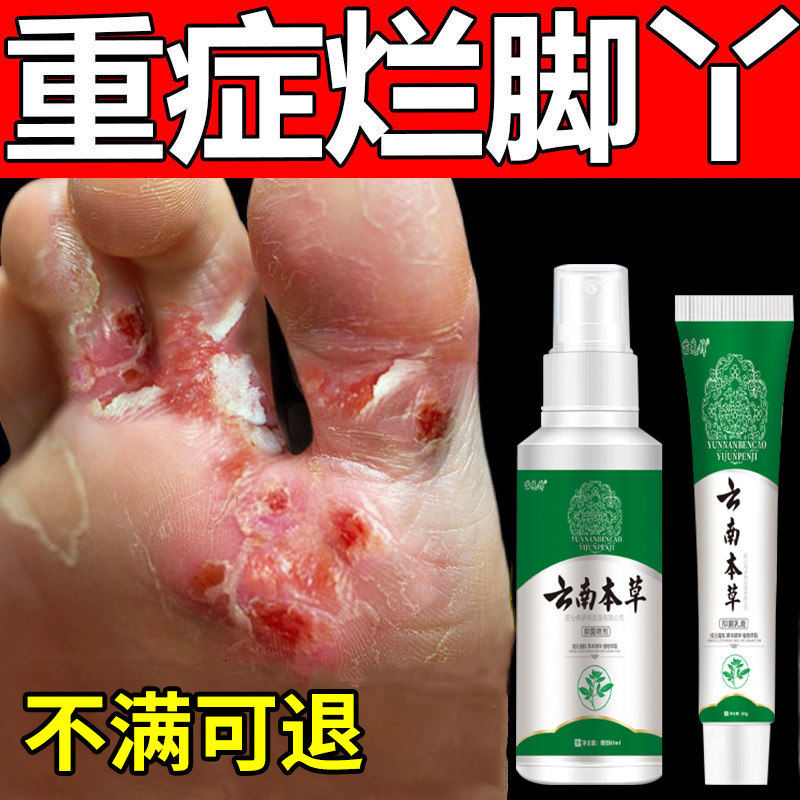 云南本草脚气喷剂烂脚丫糜烂去脚气止痒脱皮杀真菌感染专用神器xl