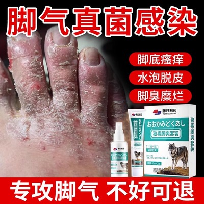 狼毒脚气喷剂喷雾臭烂脚丫脱皮糜烂脚趾缝烂痒脱皮杀菌止痒膏治uu