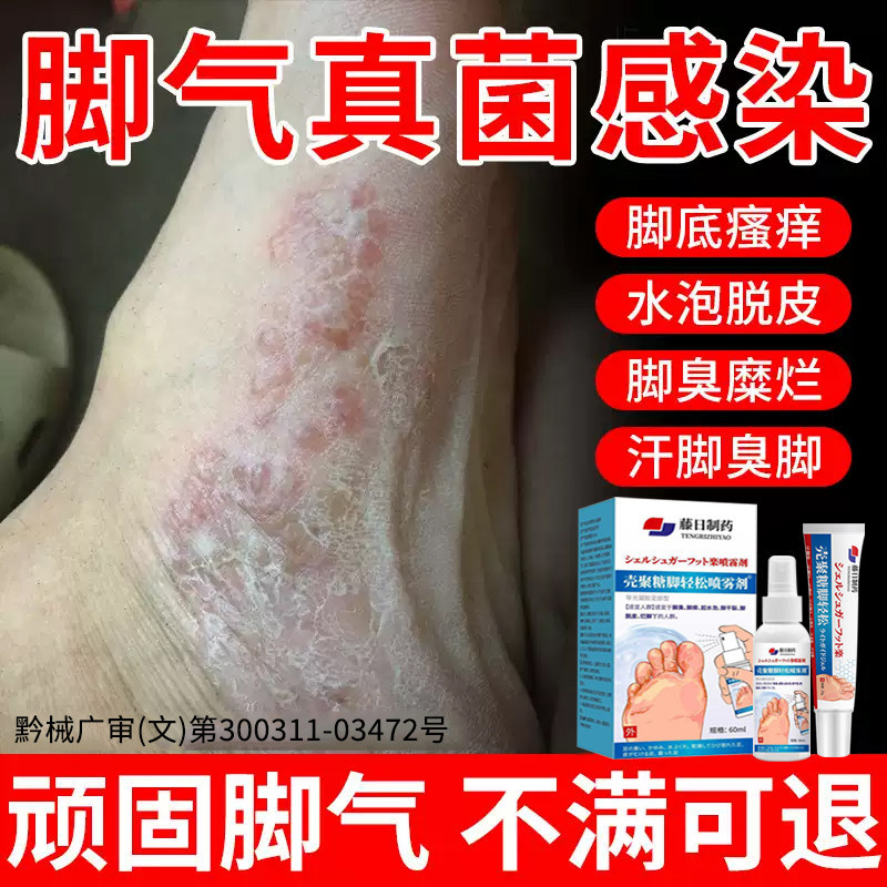 日本脚气止痒脱皮杀菌喷雾烂脚丫膏抑菌除脚趾缝糜烂神器专用膏xl