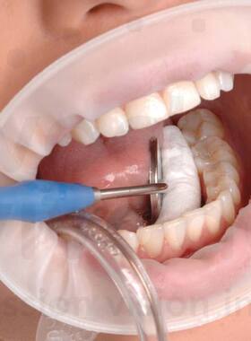 义获嘉OptraGate立体开口器 简单快捷佩戴舒适牙科口腔正品保证