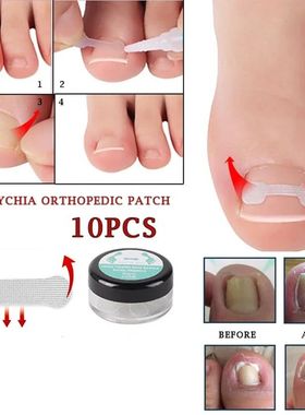 10PCS Ingrown Toe Nail Treatment Ingrown Toenail Correction