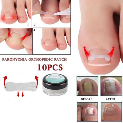 10PCS Ingrown Toe Nail Treatment Ingrown Toenail Correction
