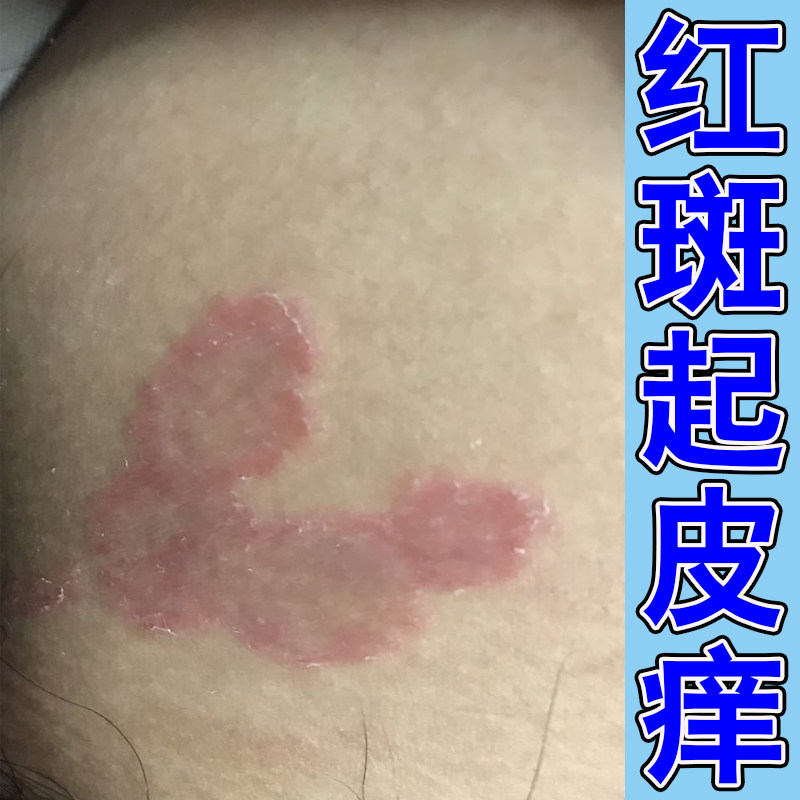 大腿内侧痒股干燥粗糙屁股长疙瘩大腿根部痒两侧长小红点痒修护膏