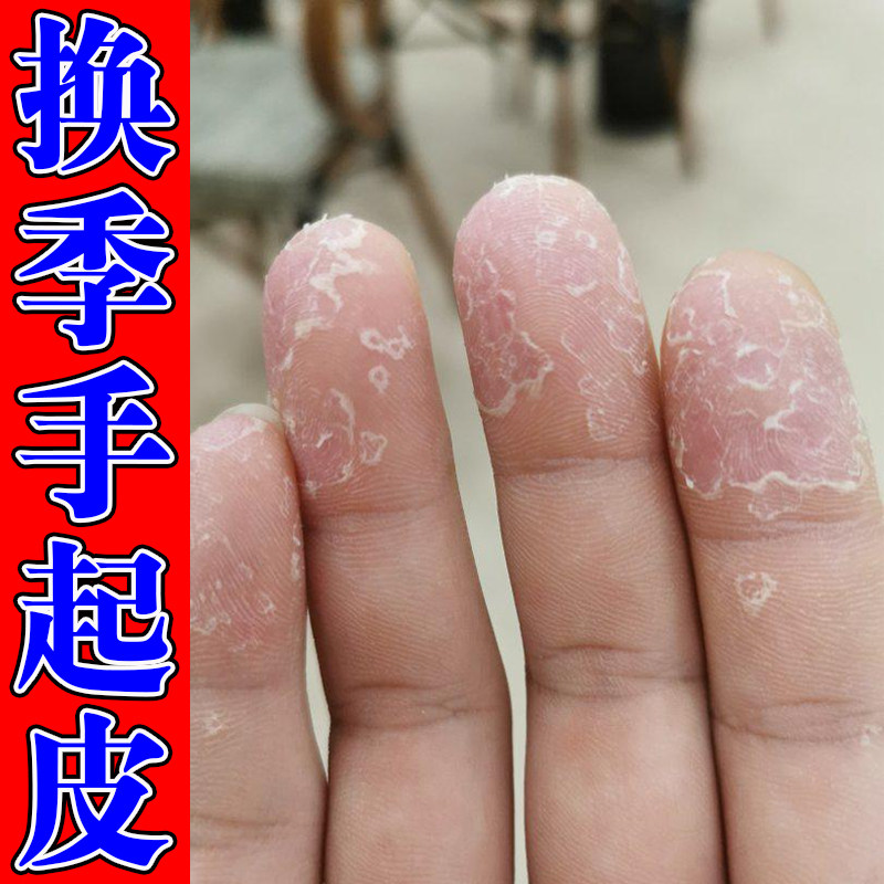 手干裂蜕皮冶季节性手掌手指干裂脚上起皮掉皮脱屑干痒膏