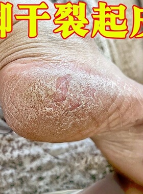 脚后跟干裂起硬皮修复药足跟开裂治脚裂角化型气脚去死皮外用软膏