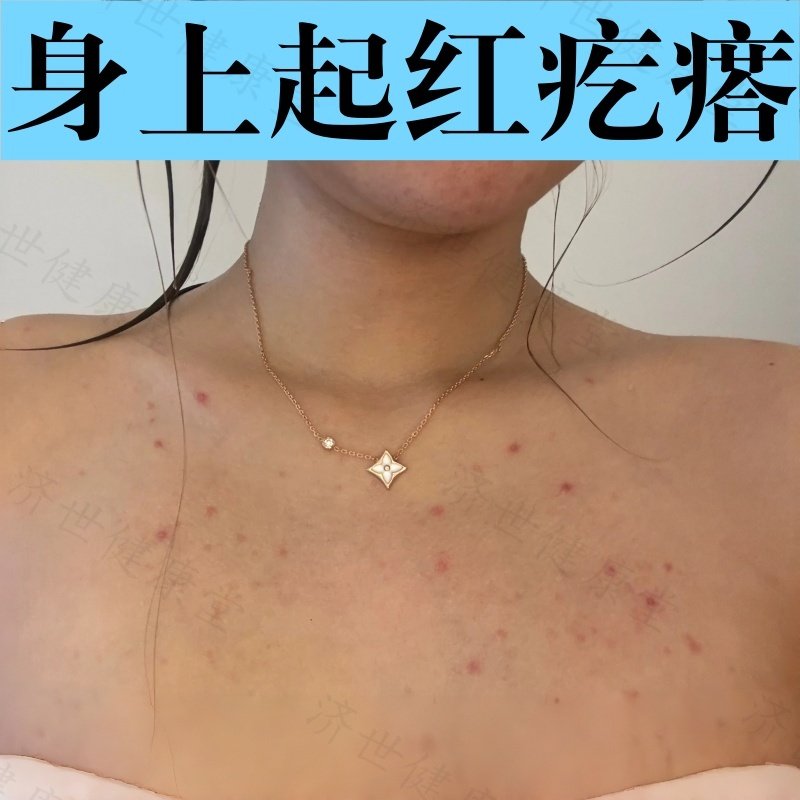 前胸后背长痘痘毛囊皮肤炎外用乳膏身上有痤疮堵塞毛孔痒止药