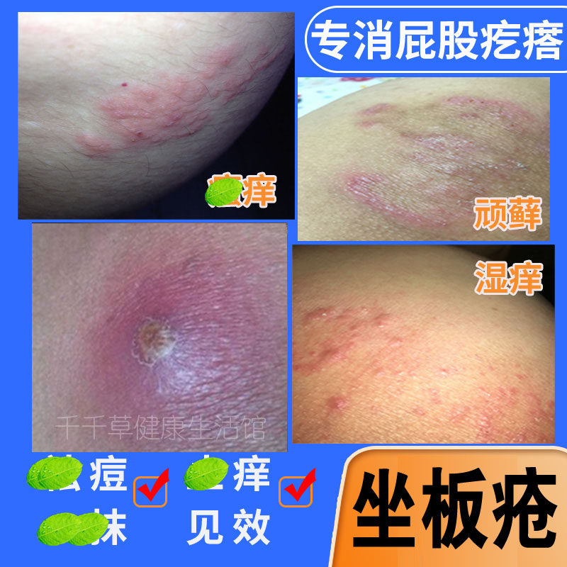 坐板疮屁股座苍膏火疖子拔毒膏解毒座疮膏疙瘩浓包坐板疮拔脓吸脓