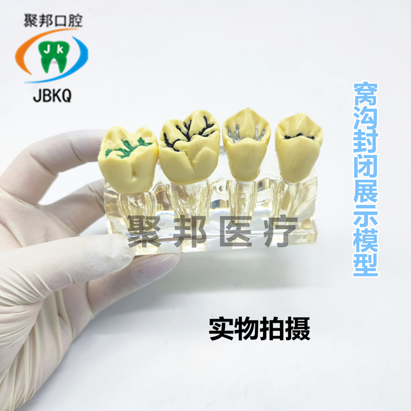 牙科模型教学演示模型医患沟通3倍放大模型窝沟封闭示范牙可拆卸