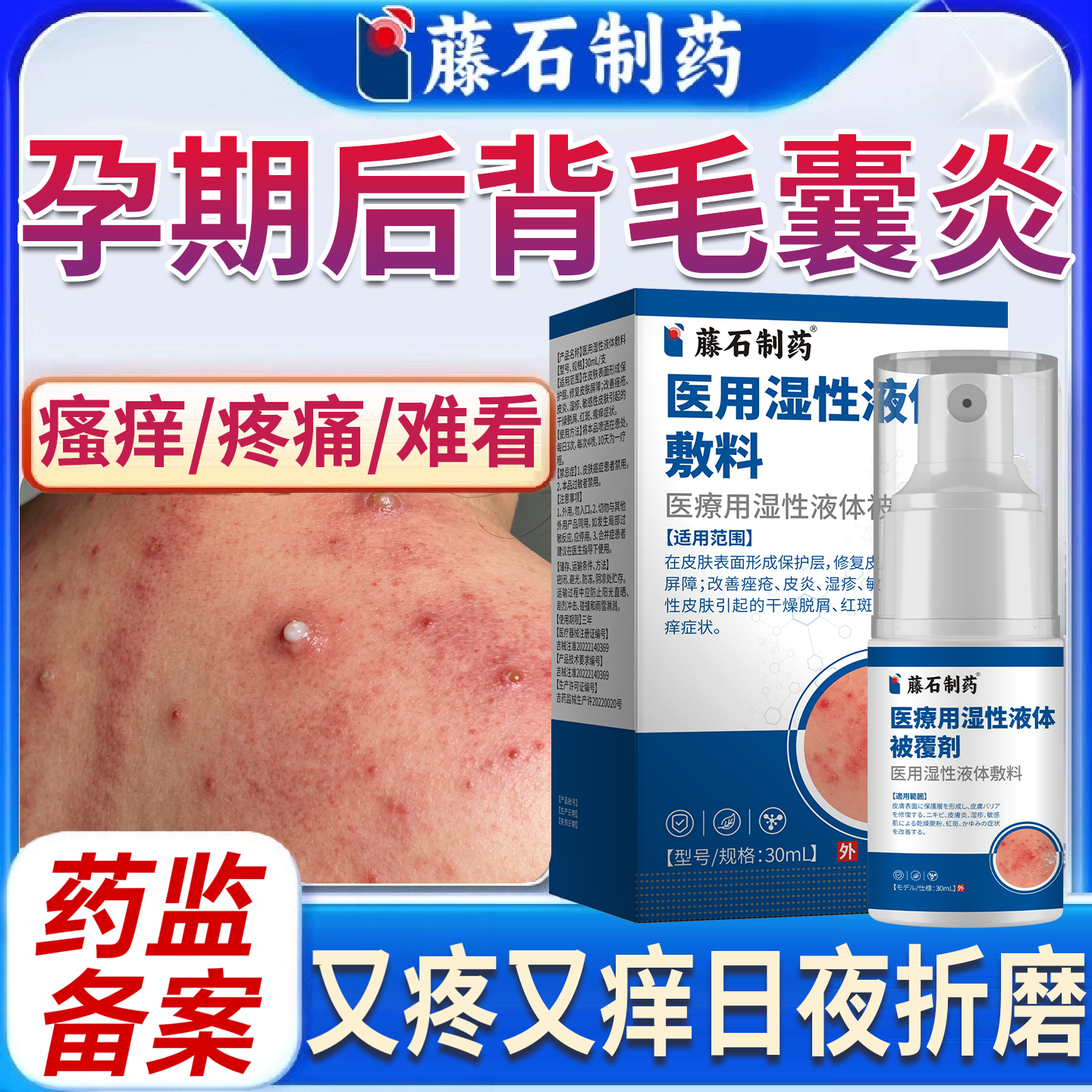 孕妇可用去除后背背上痘痘马拉色菌毛囊炎专用喷雾剂医用级祛痘P2