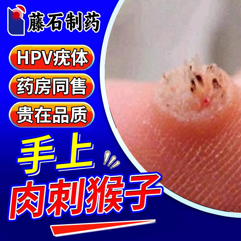 肉刺猴子药房同售膏水手上长疣瘊子肉粒根疙瘩点疣体老茧CA