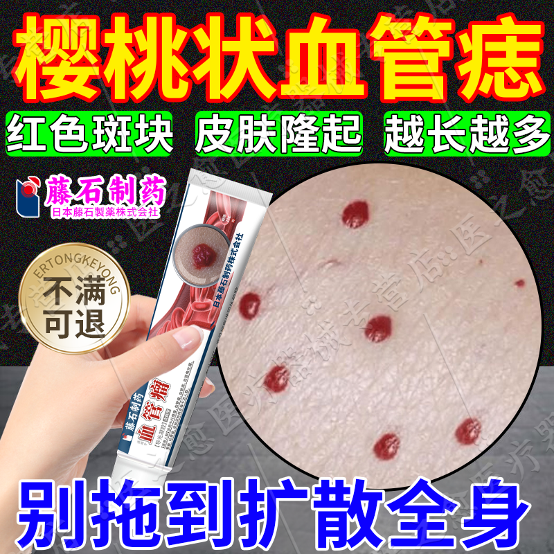 樱桃血管痣血管瘤去除毛细血管修复红痣身上脸上小红痣樱桃状pg