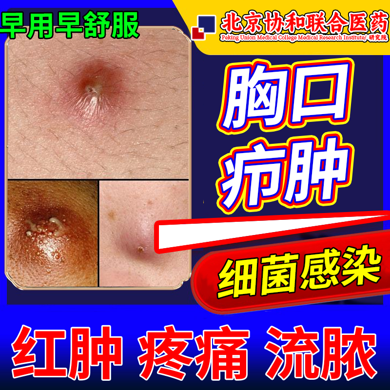 胸口长疖肿皮脂腺囊肿火疖子拔毒拔脓膏吸脓包硬块可搭配膏药贴pg