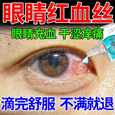 眼睛红血丝改善眼睛疲劳药水