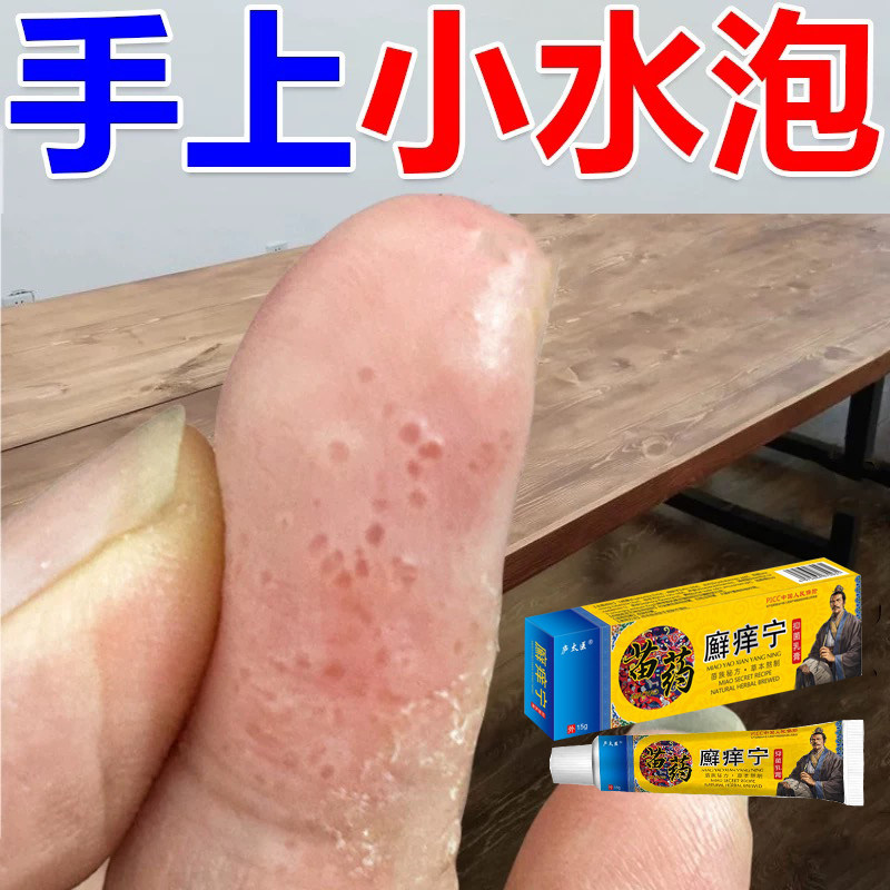 手上起小水泡手痒水泡脱皮干裂止痒膏手气膏起皮干燥季节性汗泡诊