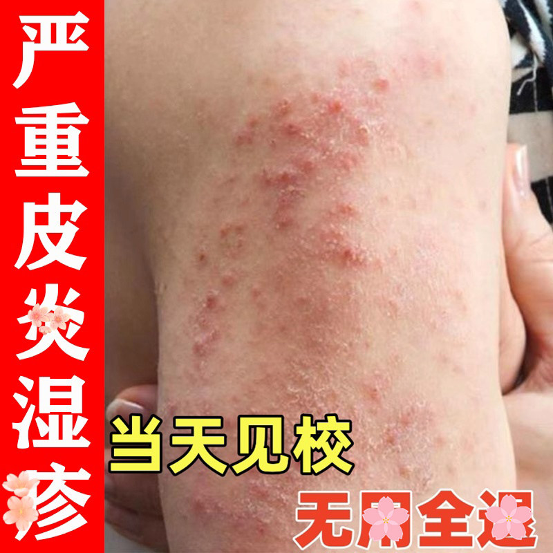 瘙痒止痒喷雾小孩身上痒儿童止痒膏结节性疹治顽固硬疙瘩