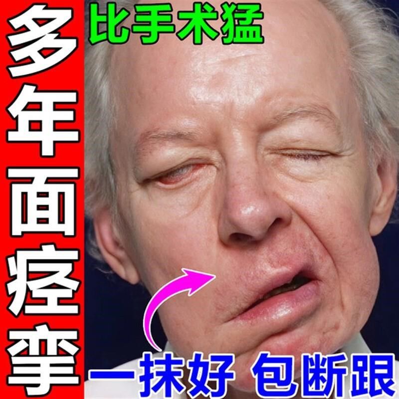 正颜康面瘫贴药鬼谷面肌痉挛药膏牵正散治仪脸部热敷