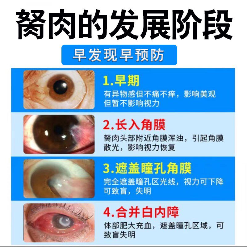 去除眼睛胬肉滴眼液专眼治角息肉翼状胬肉眼睛异物看感不清干痒疼