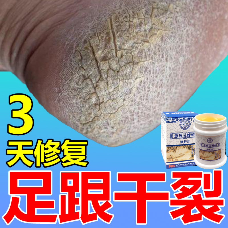 脚干裂脱皮苗家药膏手脚专治干裂真菌感染脚后跟开裂烂脚丫的药