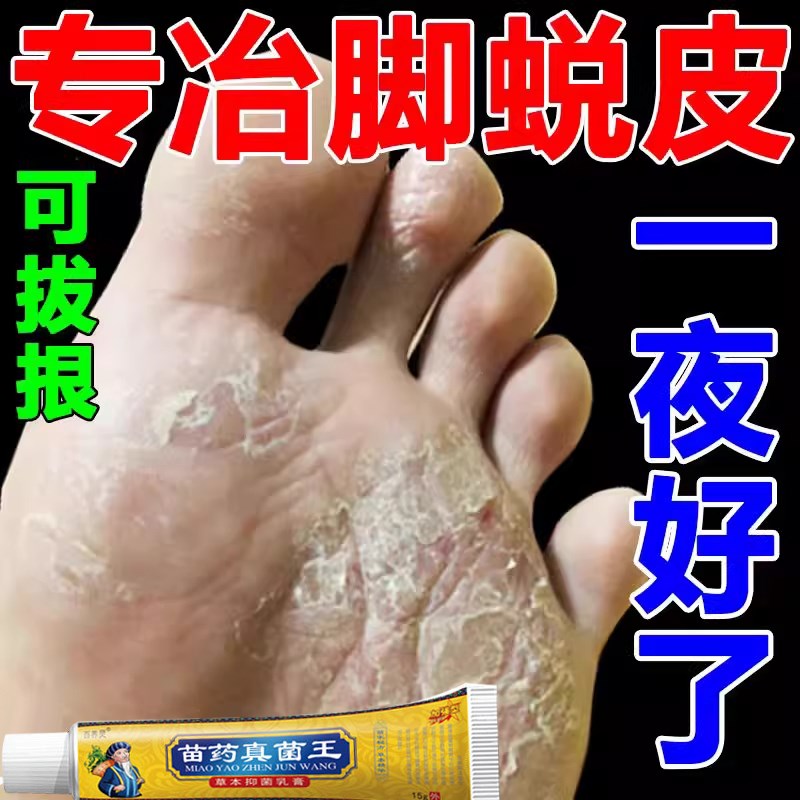 苗家真菌王苗药真菌王脚后跟干裂脱皮起皮脚趾开裂脚后跟皴裂膏