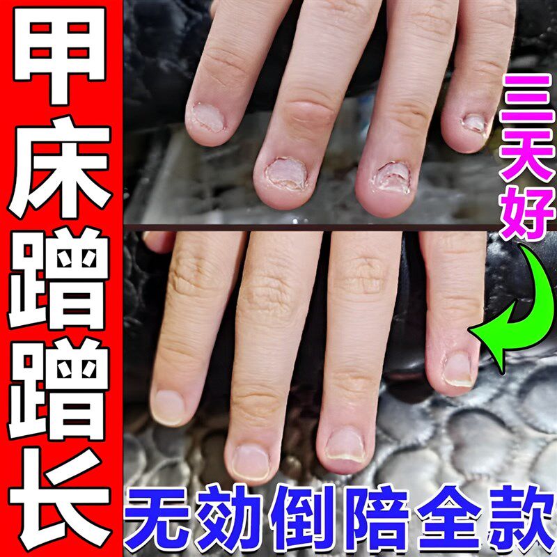 甲床修复生长液啃咬指甲受损萎缩再生甲肉分离空甲断裂护甲油增长