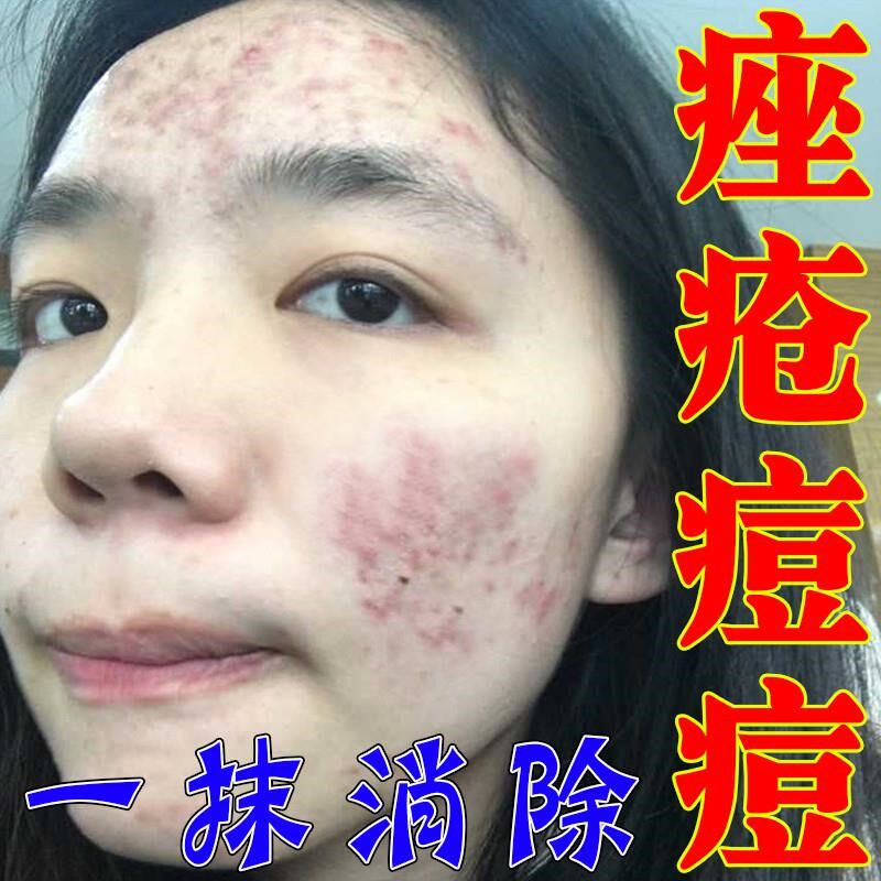 脸上长痘痘毛囊炎内分泌失调上火熬反复长痘脓包痤疮专用修复乳膏