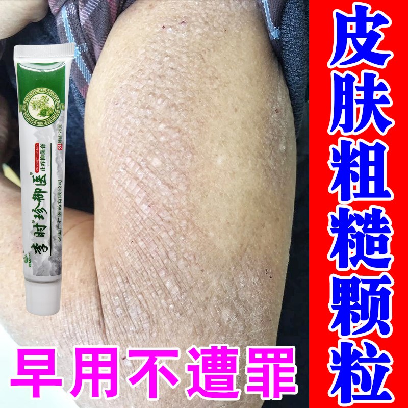 皮肤淀粉样变奇痒无比皮肤粗糙颗粒感硬结节小疙瘩黑色素沉积药膏
