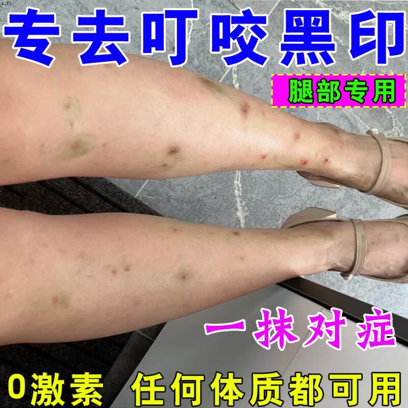 去蚊子叮咬疤印蚊虫祛疤膏除疤去皮肤黑色素沉淀磕碰后留疤去黑膏
