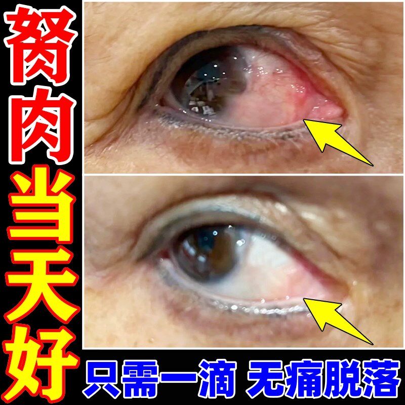 去除眼睛胬肉滴眼液眼睛浑浊看不清有异物翼状息肉疙瘩干痒眼水
