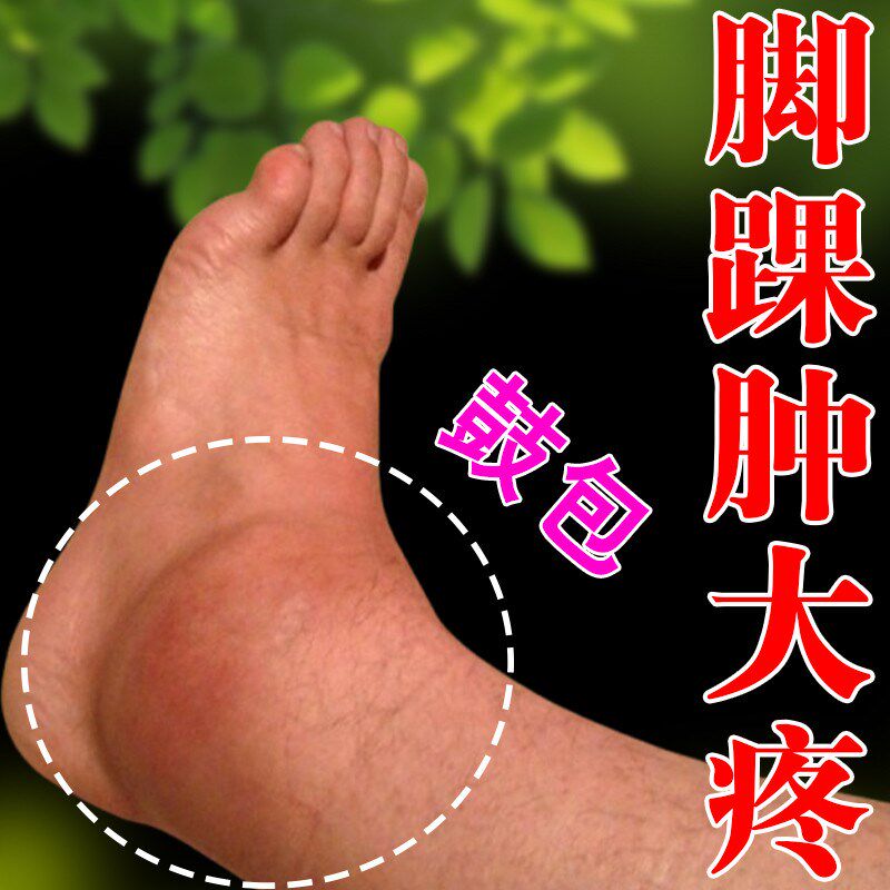 脚踝鼓包腕关节损伤扭伤骨裂脚脖子水肿疼痛变形一动就疼活血化瘀